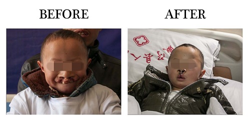 受助患兒李選向術前術后照片