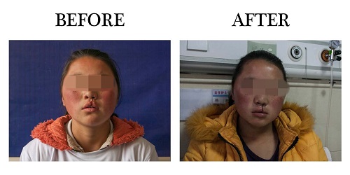 受助患兒鄧稱術前術后照片